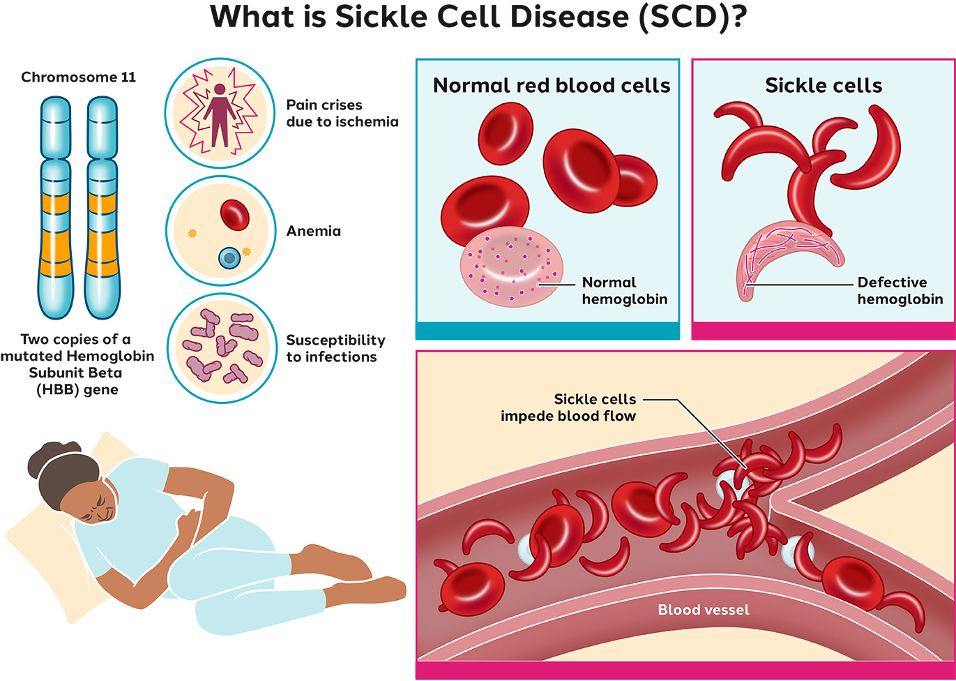 sickle-cell-disease-causes-fenetics-symptoms-diagnosis-44-off